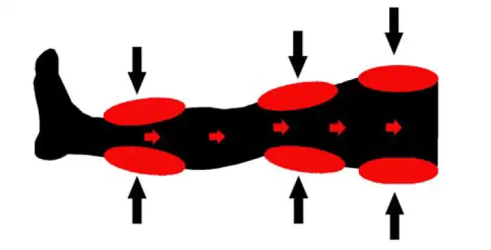 ECP_MedMedBed_Inflation Illustration of ECP Med Bed Inflated Cuffs (shown in red) placed on a leg in three different positions.