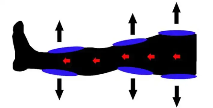 MedBed_Deflation Illustration of ECP Med Bed Deflated Cuffs (shown in blue) placed on a leg in three different positions.